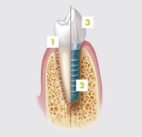 implantes Dentales Madrid Clinica dental Bonadent que es un implante