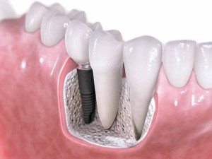 Que es un Implante Dental