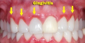 Gingivitis en Madrid , fotos de pacientes co signos de gingivitis