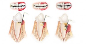 Periodontits y perdida de soporte dental