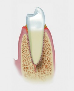 periodontitis leve en Madrid tratamiento