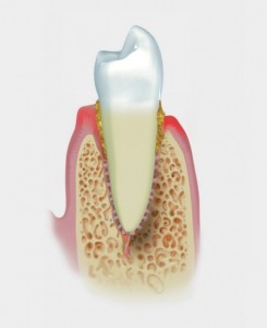 Periodontitis severa en Madrid clinica Dental Bonadent