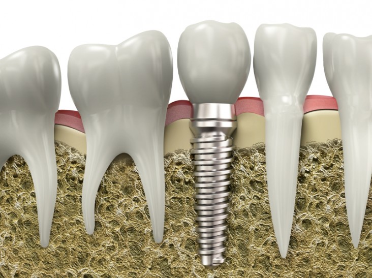 Que saber antes de colocarse un implante dental